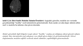 YolovX ile Beyin Tümörü Tespiti