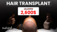 Hair Transplant Meta Add for Natural Clinic
