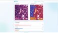 PulmoPath – Yapay Zekâ ile Histopatoloji Analizi