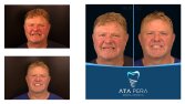 Before After Posts - ST