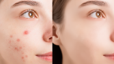 Retouch işlemi