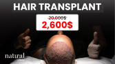 Hair Transplant Meta Add for Natural Clinic