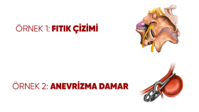 Tıbbi damar lezyonu ve fıtık illüstrasyonu