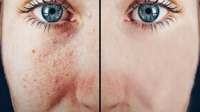 profesyonel olarak yüz temizleme (retouch) yapabilirim