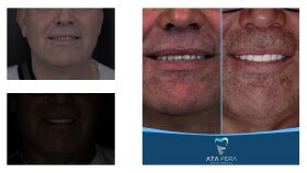 profesyonel before after postları hazırlayabilirim