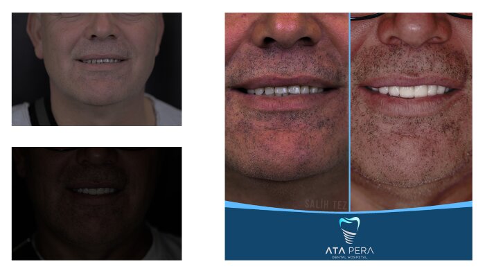 profesyonel before after postları hazırlayabilirim
