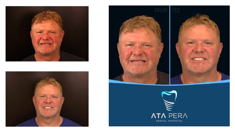 Before After Posts - ST