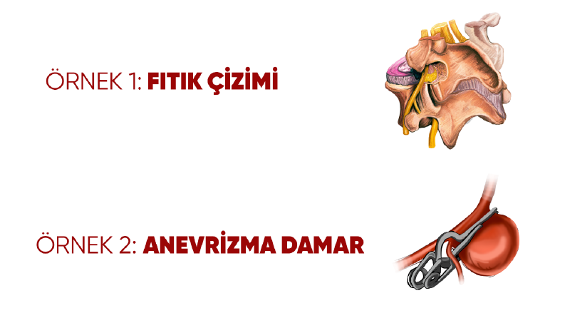 Tıbbi damar lezyonu ve fıtık illüstrasyonu